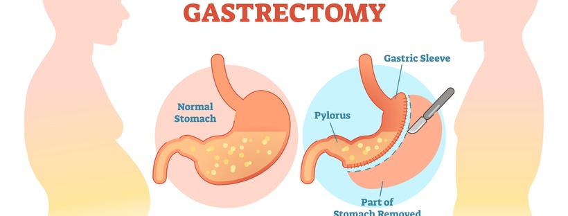 Γαστρικό Μανίκι – Sleeve Gastrectomy