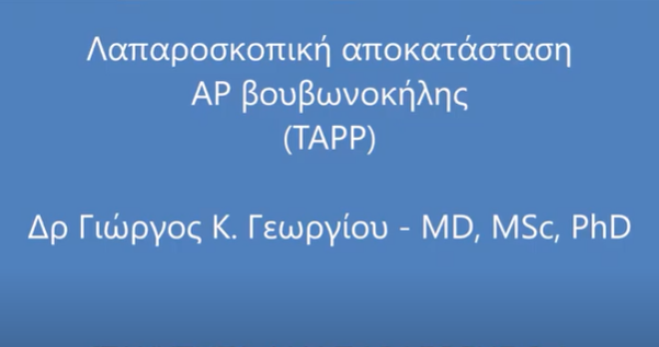 Λαπαροσκοπική αποκατάσταση αριστερής βουβωνοκήλης (TAPP)